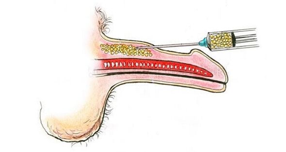 Injections of hyaluronic acid into the barrel of a member in order to increase it